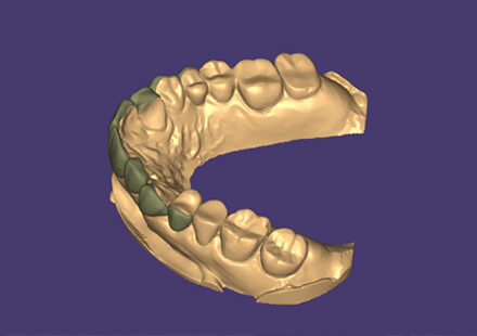 口腔内データ分析、模型分析、プロビショナル